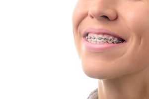 A young lady with dental braces in TX smiles