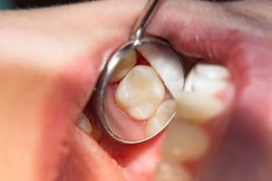 dentist looking for lost fillings