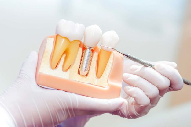 dental-implants-1 a model of dental implants