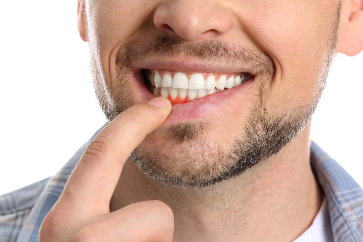 gum-disease man with bleeding gum because of gum disease