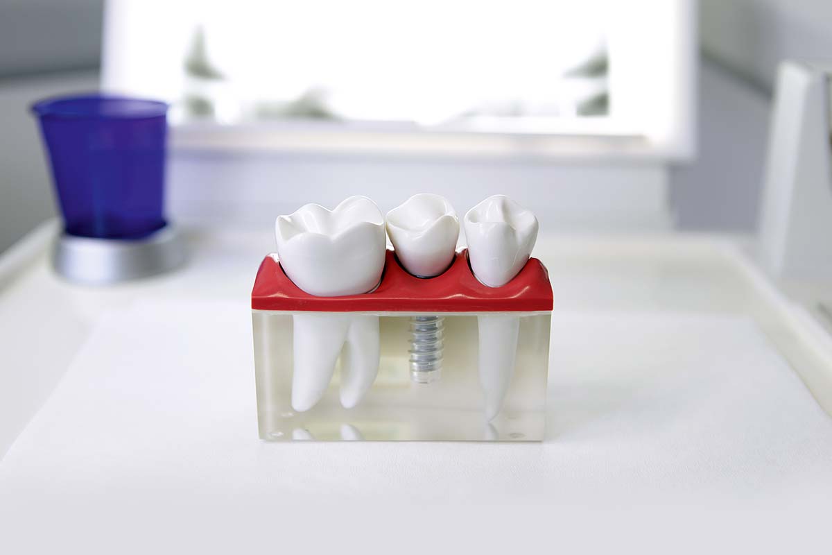 a model of the different types of dental implants