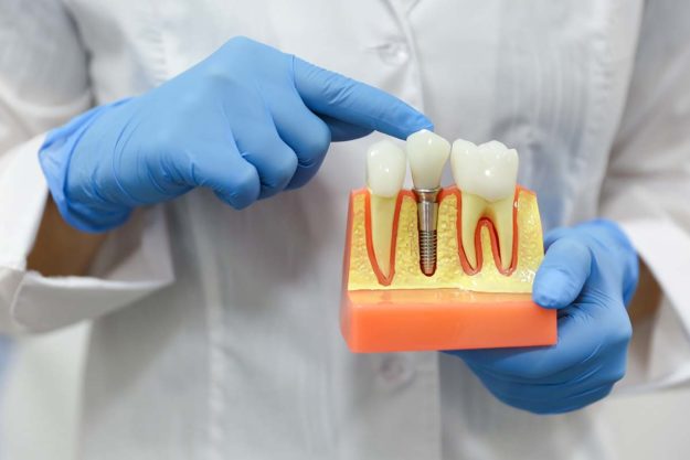 dental-implants(1) a dentist holds dental implants as he explains how long dental implants last