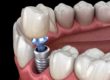 example of a single tooth implant