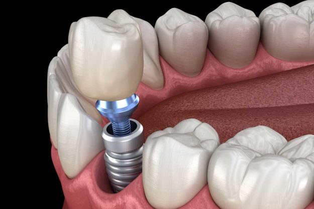example of a single tooth implant