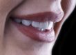 benefits of dental veneers