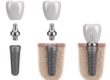 how do dental implants work gulfgate texas
