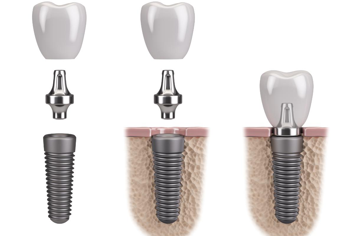 How Do Dental Implants Work how do dental implants work gulfgate texas